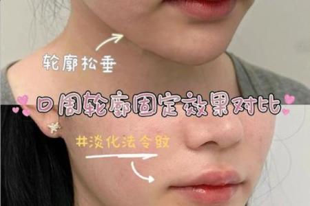 嘴角八字纹不再是问题，有效方法让你重拾光滑肌肤